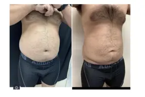 Before and after  Liposuction Male by Medical Cosmetic Enhancements Dr Varano in Washington DC